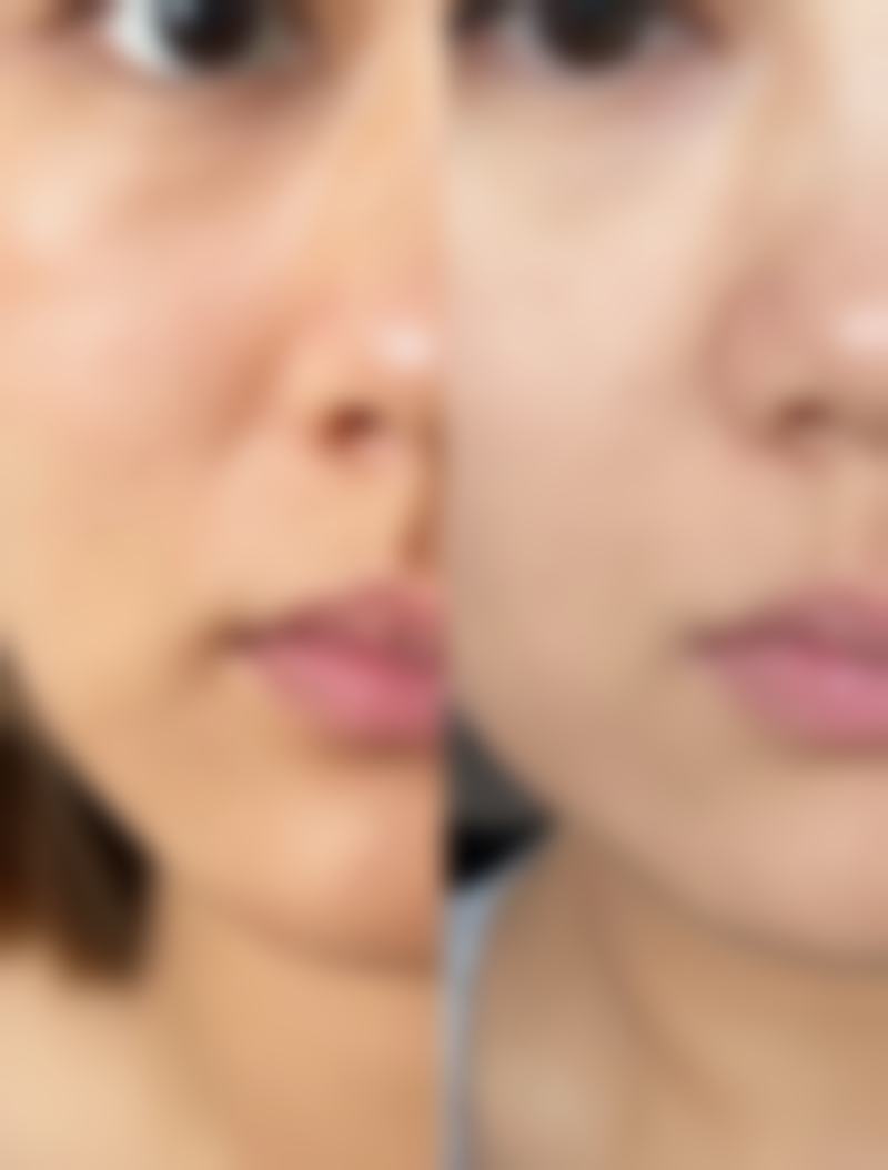 眼袋手术两侧不对称修复要注意什么：遵循要点促进修复