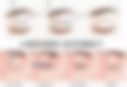 割双眼皮多久能健身？术后1周可散步，1个月恢复剧烈运动需谨慎