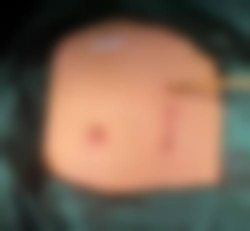 郭晓辉医生做手术价格