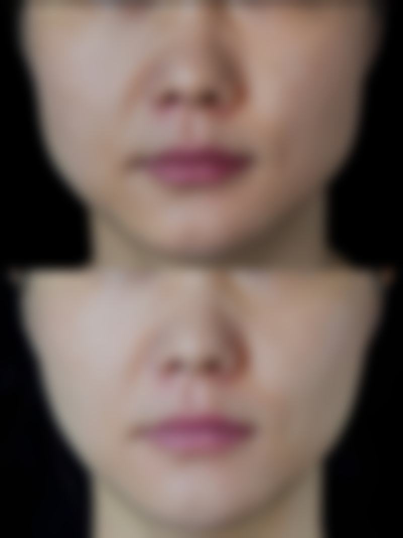 隆鼻后饮食全指南:从忌口到解禁