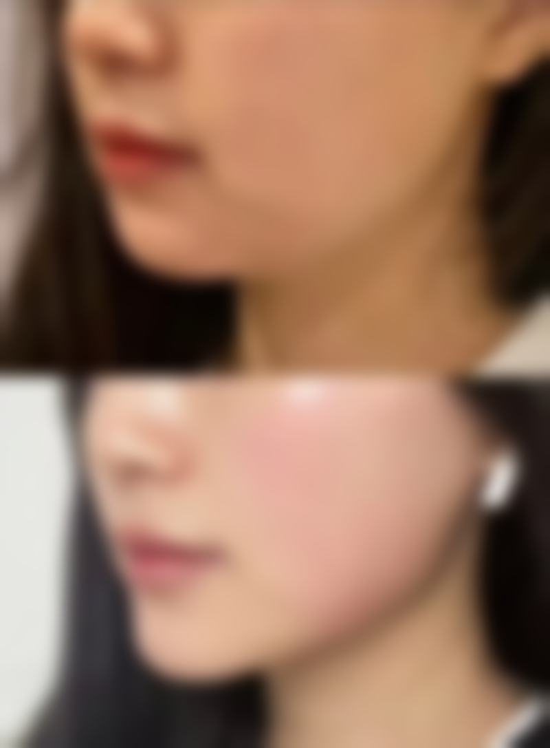 割双眼皮多久能健身——健身时必看保命指南