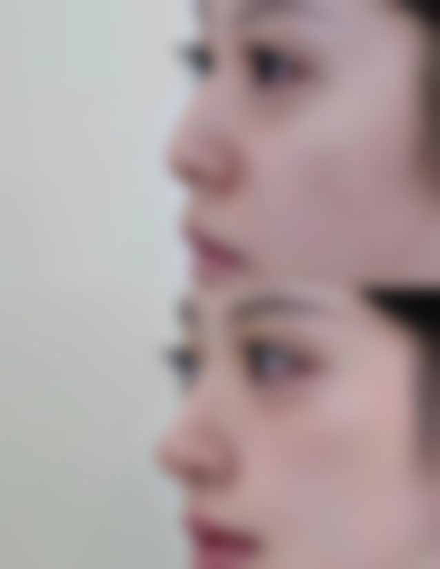 割双眼皮多久能健身——术后2 - 3周:轻度试探期