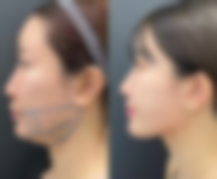 膨体隆鼻:自然派代表,隆鼻手术材料中的自然之选