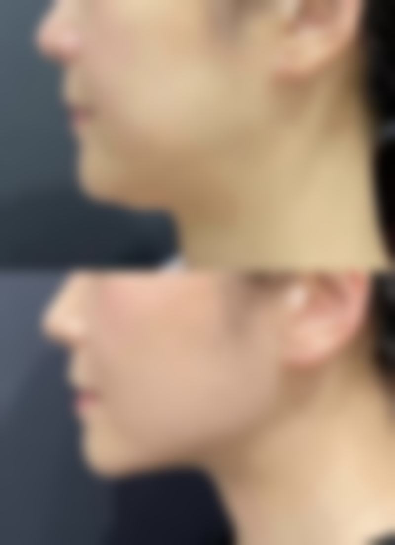 怎么去除黑的疤痕之药物治疗：从源头狙击黑色素