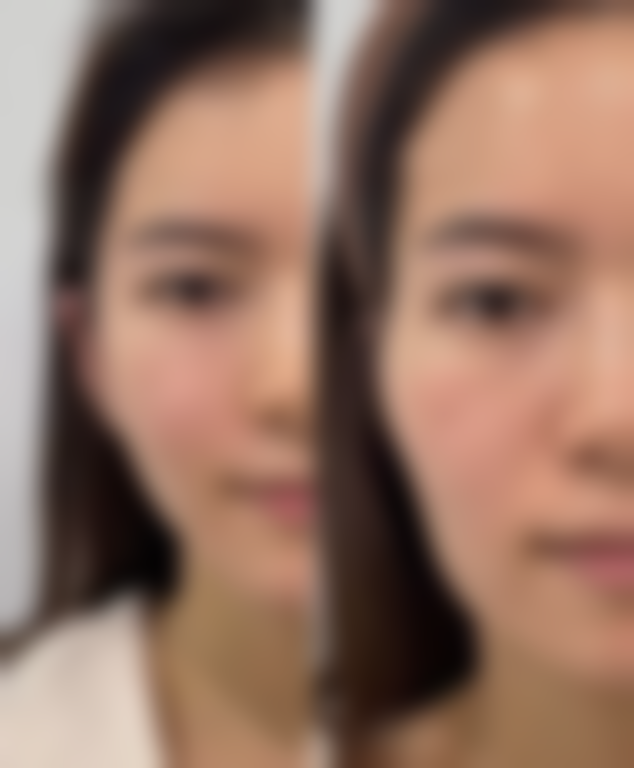 怎么去除黑的疤痕之治疗周期和预期成效