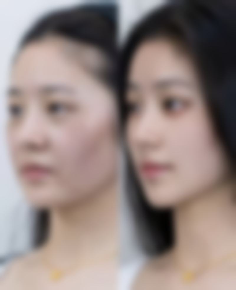 怎么去除黑的疤痕之激光 + 药物：1 + 1 > 2的理想组合