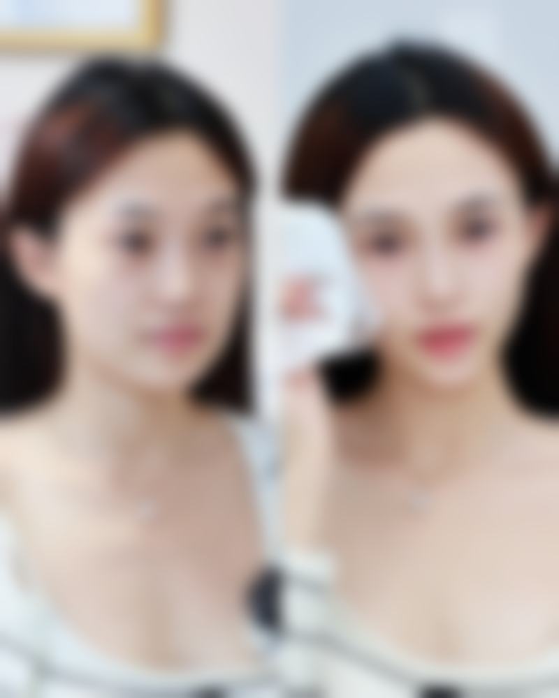 假体隆胸的效果能保持多久？北京上海专家揭秘10-20年保养秘诀