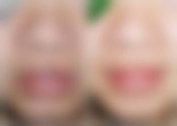 薛红宇医生析埋线双眼皮的缺点