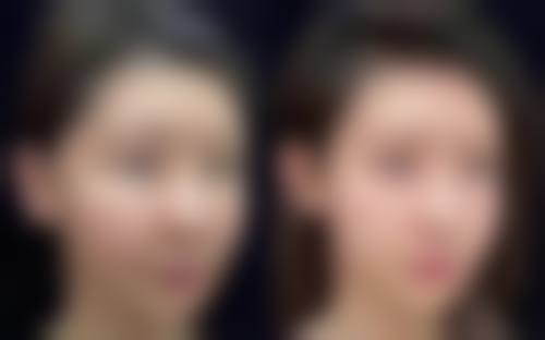 金柯桥整形医院夸割双眼皮的个性化设计