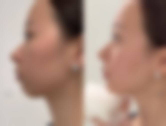 抓伤的伤疤痕迹怎么消除：医院讲解祛疤膏正确打开方式