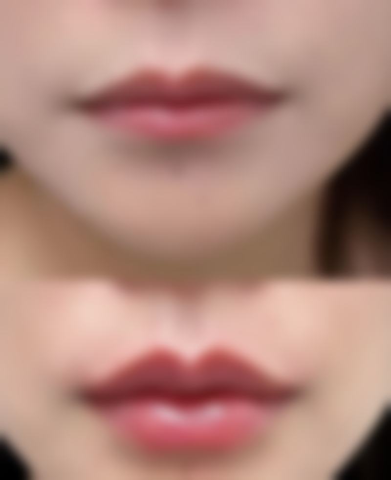 怎么消除男士下眼袋：医美手段——终极解决方案