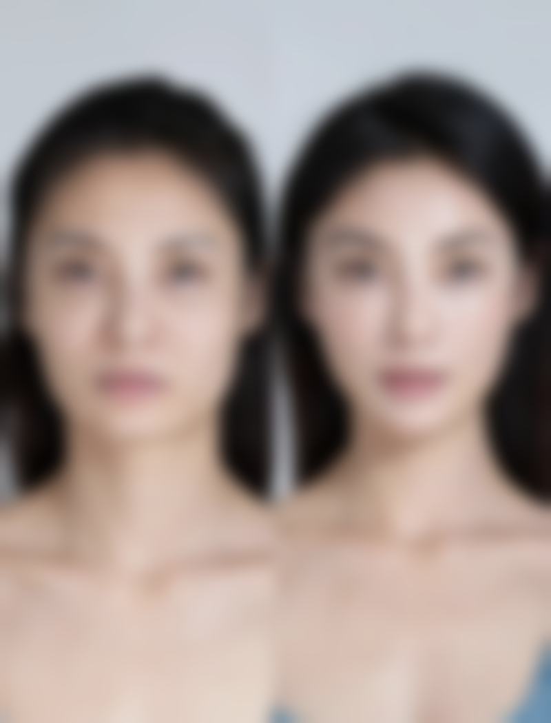 隆鼻山根高怎么办？修复手术+消肿护理，3招教你变自然美鼻