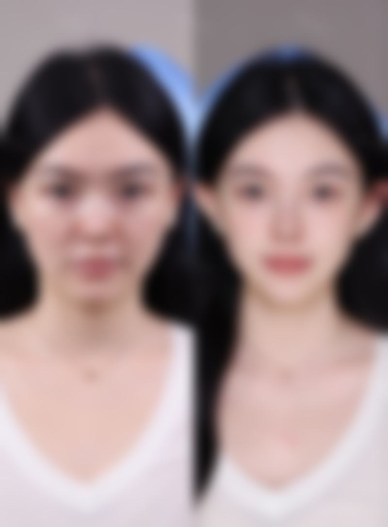 女性 vs 男性疤痕体质的差异——性别因素下疤痕体质的不同表现