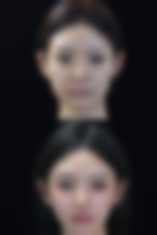 隆鼻山根高修复怎么办——把握手术时机至关重要