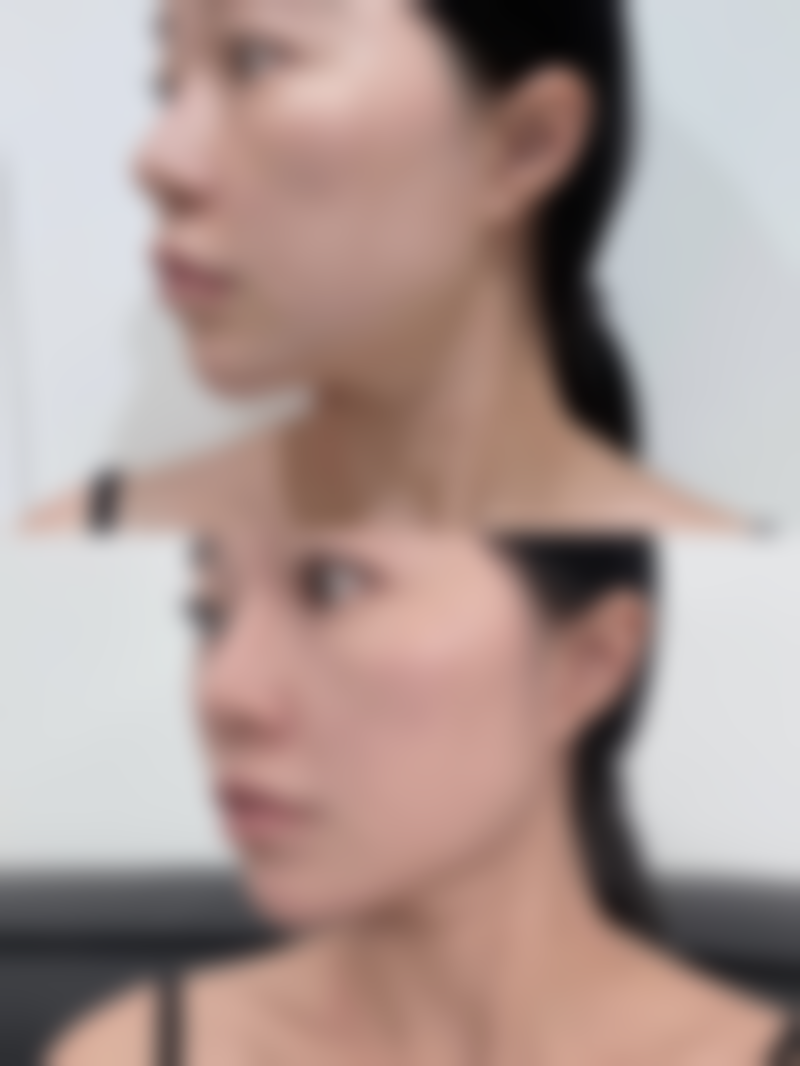 刘亚莉医生做手术价格