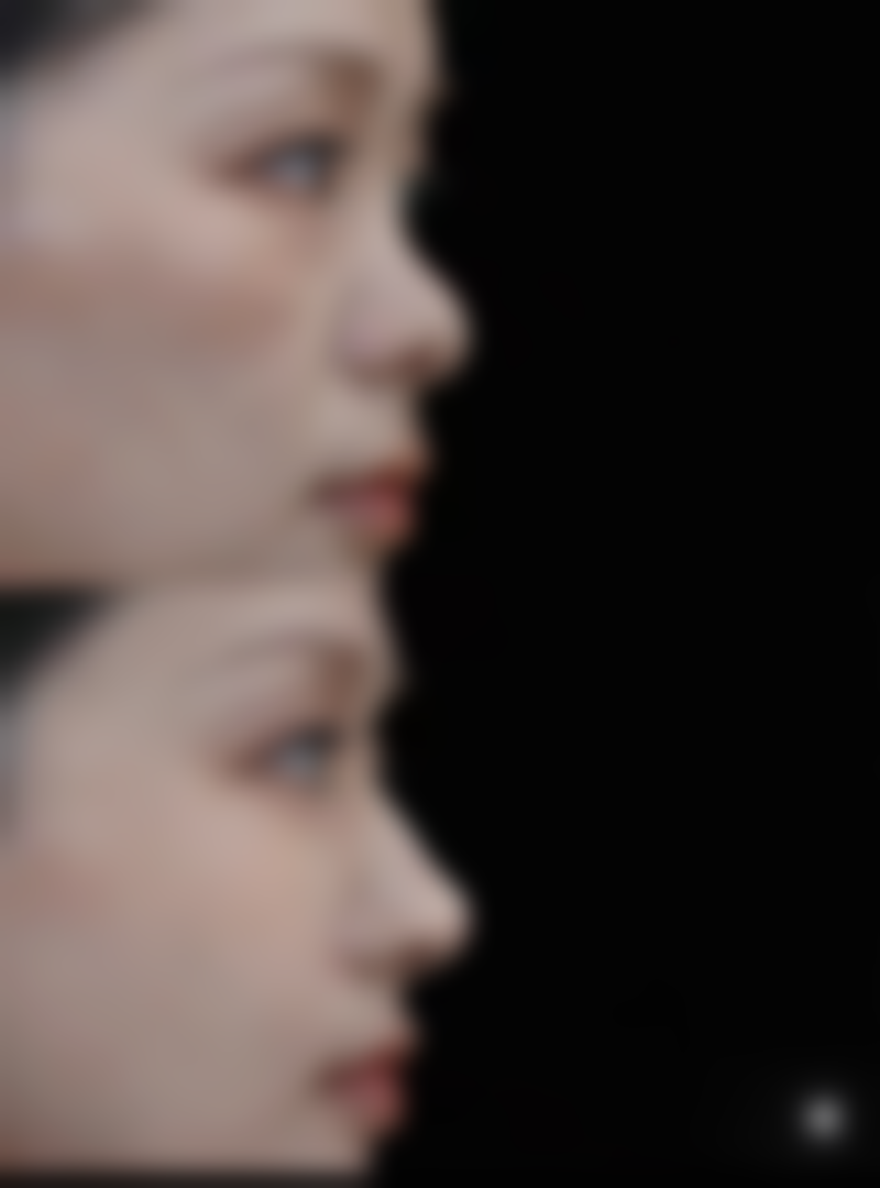 眼皮厚适合哪种双眼皮：新月型双眼皮——厚眼皮的“甜美陷阱”