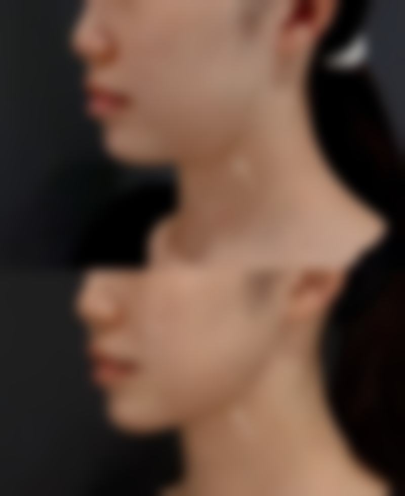 夏天能做双眼皮吗之出汗风险与应对