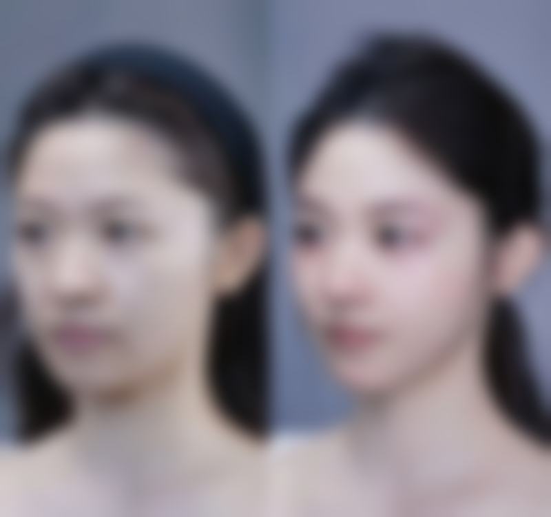 外伤疤痕一般多久可以淡化及修复规律