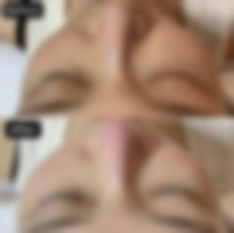 用冰敷可以把眼袋除掉吗？冰敷原理+正确方法，3天见效不反弹