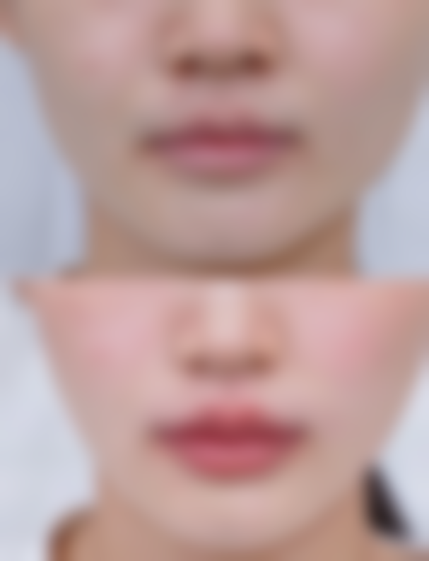 50岁的女人隆胸注意事项有哪些——全程守护