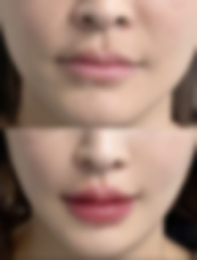 新鲜芦荟可以直接涂在疤痕上吗？3种正确用法+过敏测试，新老疤痕效果大不同！