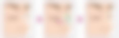 吸脂一个半月还能瘦吗？体重体型双下降，局部脂肪持续减少中