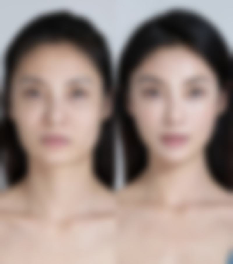 聚乳酸3.0微球:新型隆胸材料,长效再生优势明显