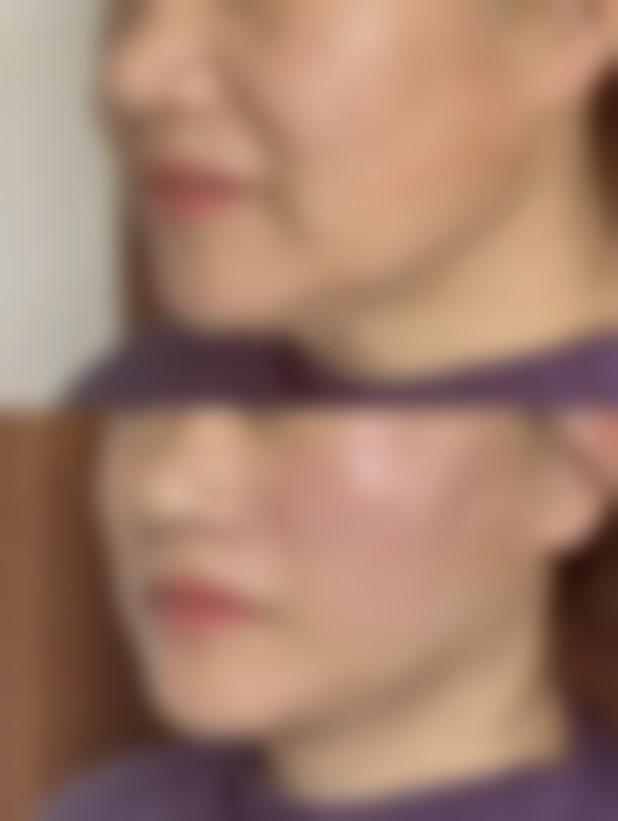 绿毒瘦脸针——你的瘦脸新选择！