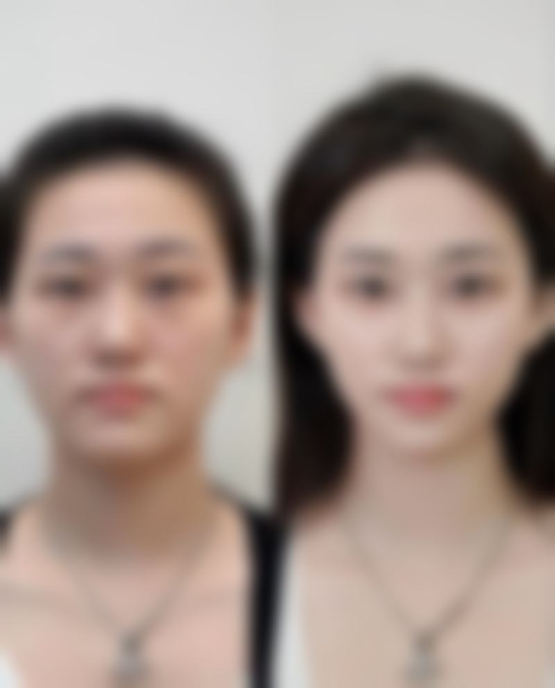 重庆医 科 大学附属第二医院揭秘：吸脂一个半月身体还会继续变瘦吗