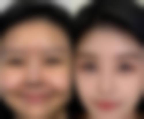 打瘦脸针脸肿怎么消肿