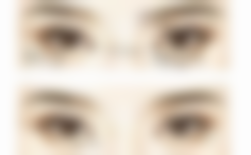 打瘦脸针脸肿会留后遗症吗