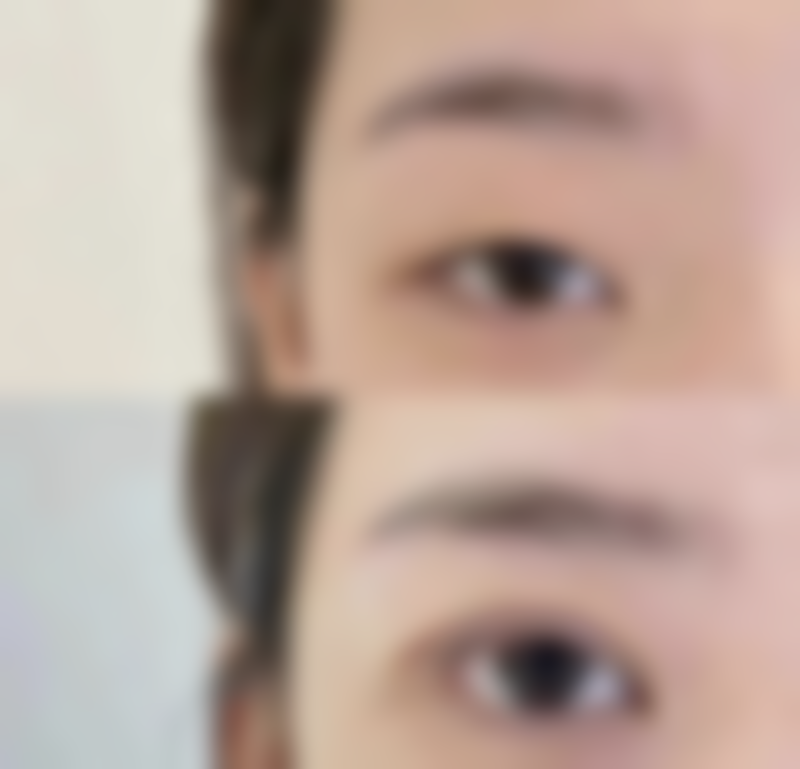 打瘦脸针后脸肿多久能消退