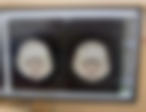 疤痕增生黑色素沉淀多久消:不同类型疤痕的修复差异