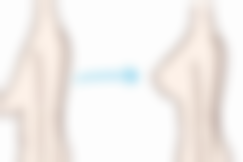 广州&深圳医院埋线双眼皮能管多少年