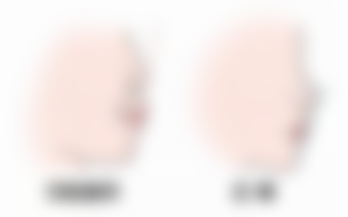 成都&杭州&南京医院埋线双眼皮能管多少年