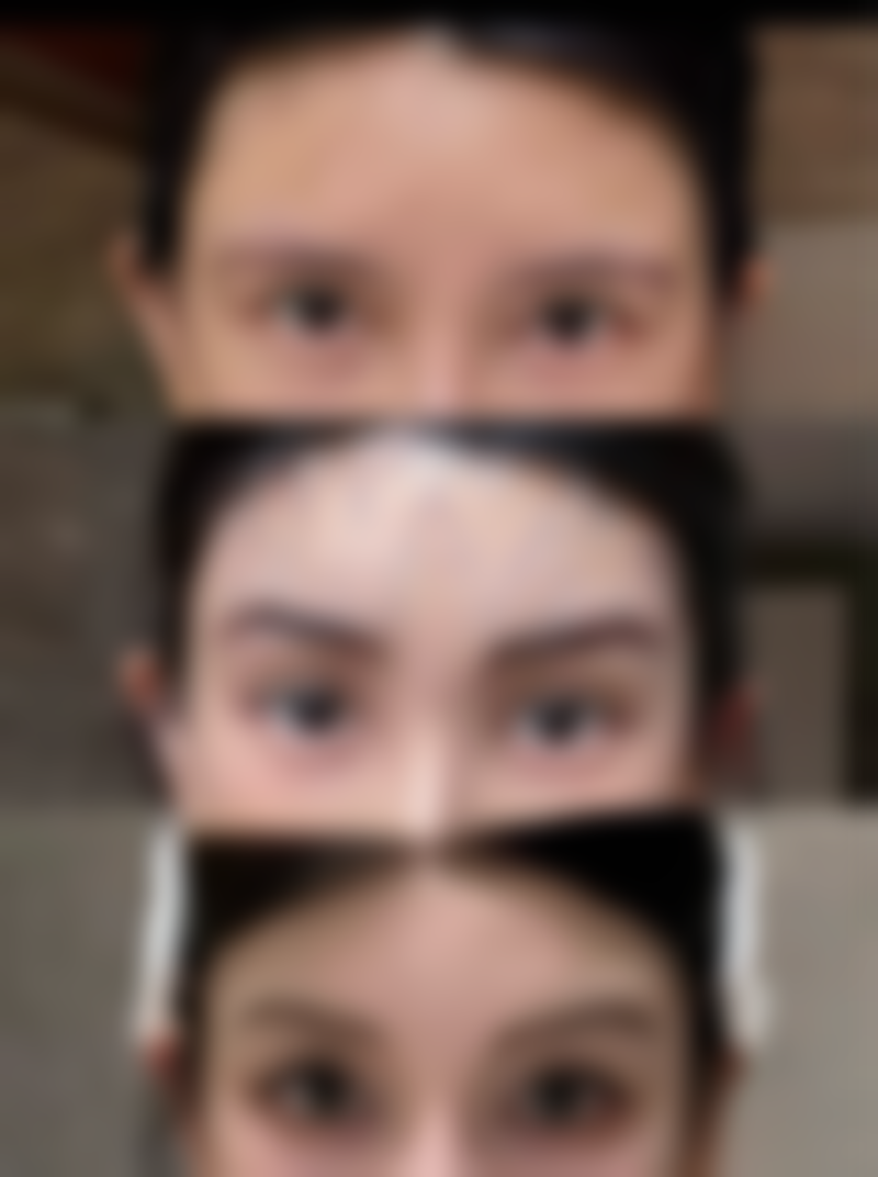 埋线双眼皮能管多少年？3-8年因人而异，北京上海医生技术大揭秘