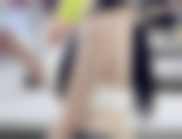 刀疤疤痕如何修复：手术修复——外科医生的“精细艺术”