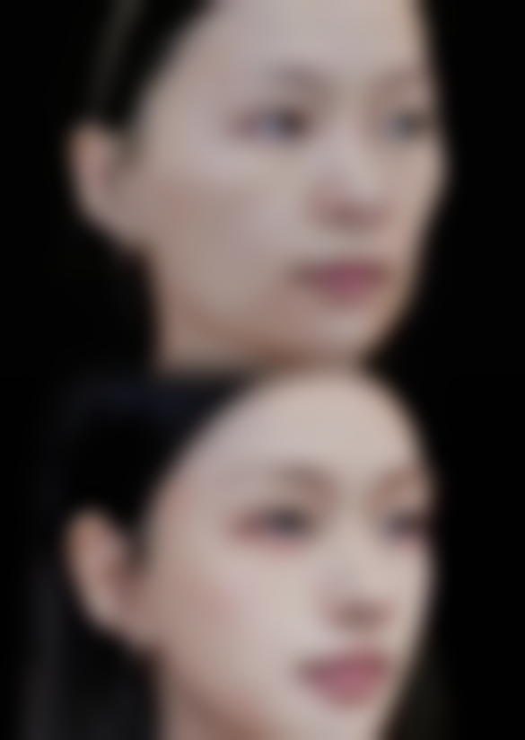 刀疤疤痕如何修复：费用解析——预算你的“美丽投资”