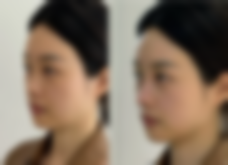 刀疤疤痕如何修复：注意事项——修复路上的“重要贴士”