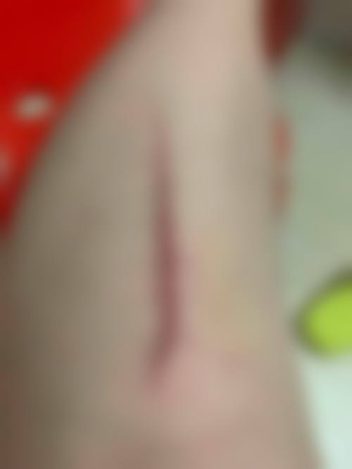 常州悦来悦美整形医院真实患者口碑评价