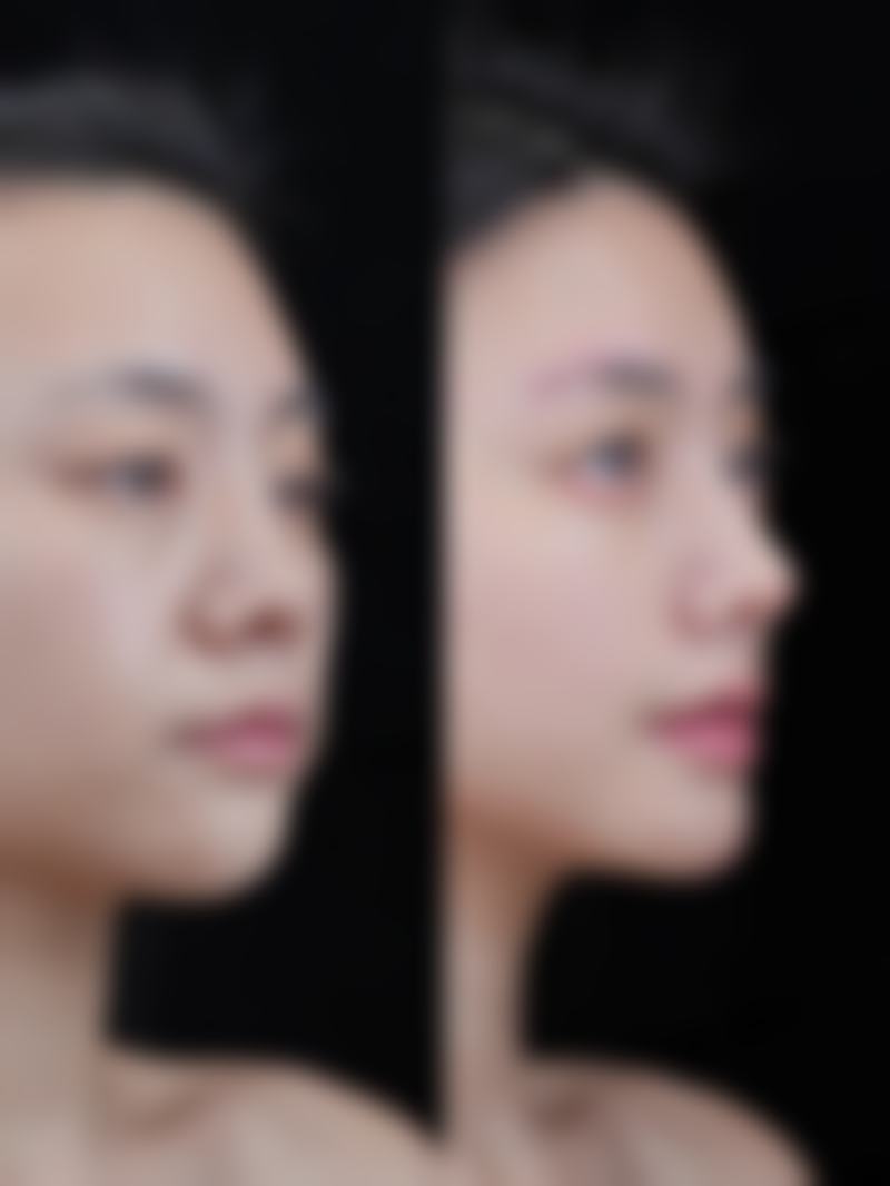 割过的双眼皮有疤痕之激光修复方案