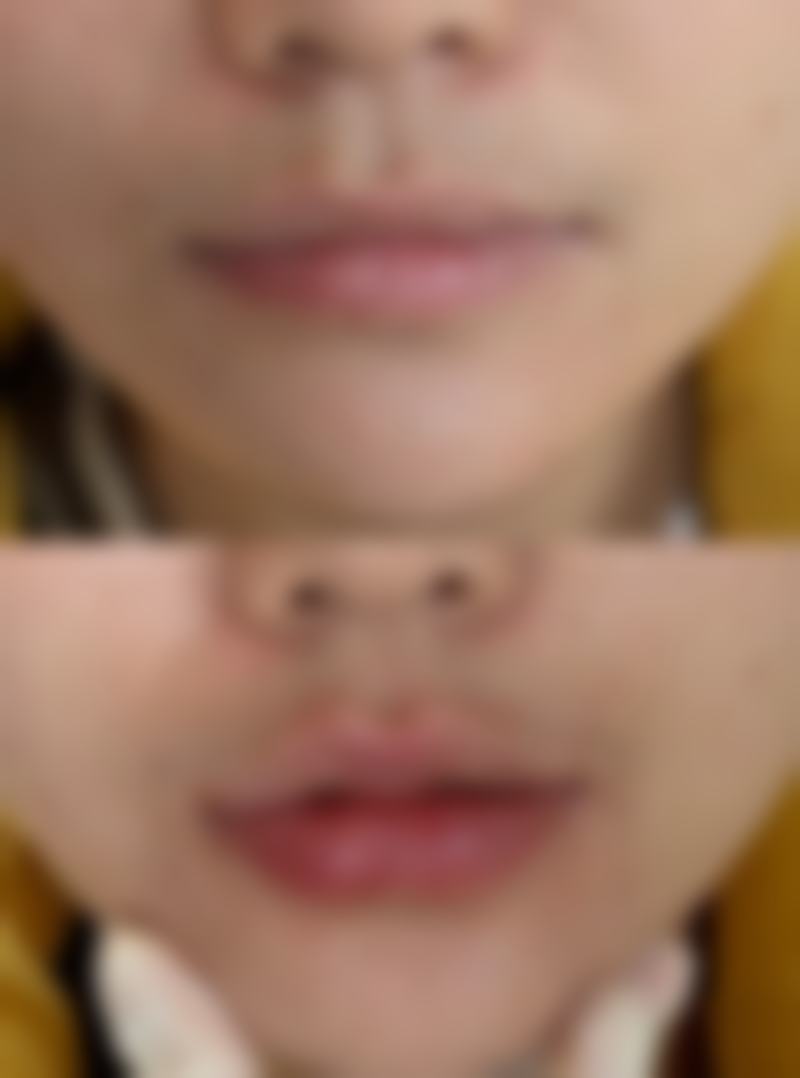 隆鼻后鼻子不通气正常的表现有哪些