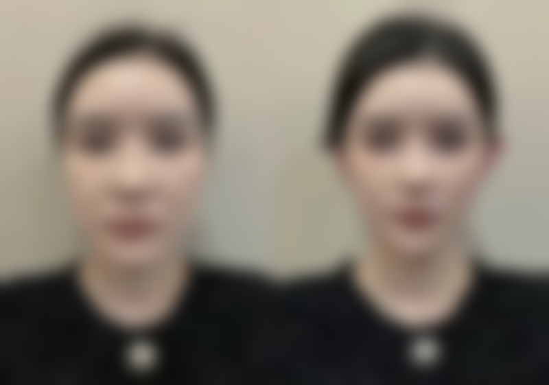 宝尼达隆鼻多久修复更好状态——术后护理关键期：这些雷区千万别踩！