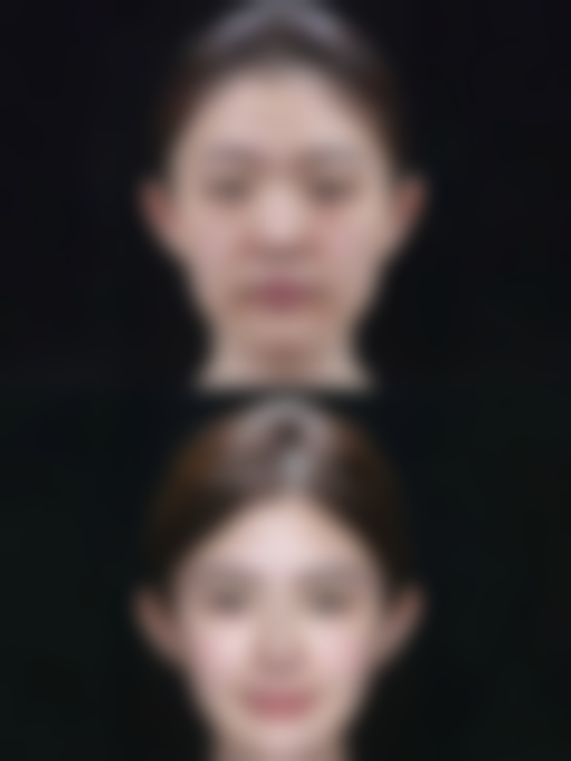 宝尼达隆鼻多久修复更好状态——影响修复时间的5大关键因素