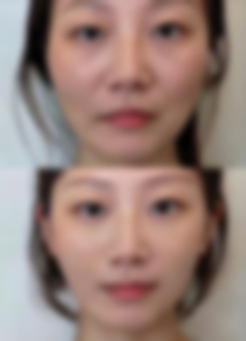 如何消掉熬夜的眼袋之医院治疗方案:当家庭护理不够时