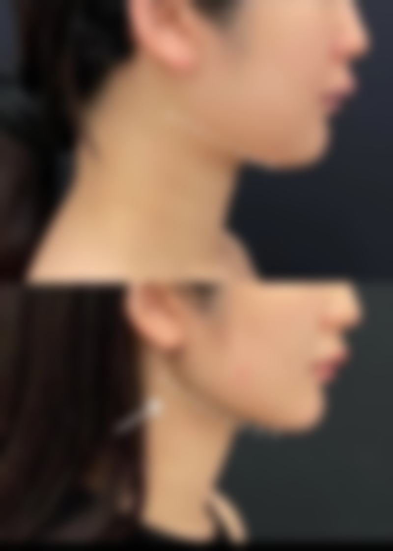 宝尼达隆鼻多久修复更好状态——价格参考（仅供参考，具体以医院为准）