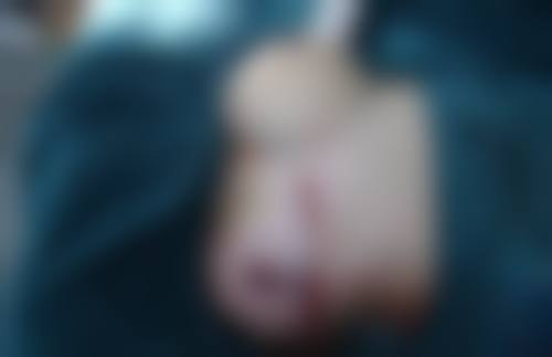 除皱针打一次能管多久之至佳成效期