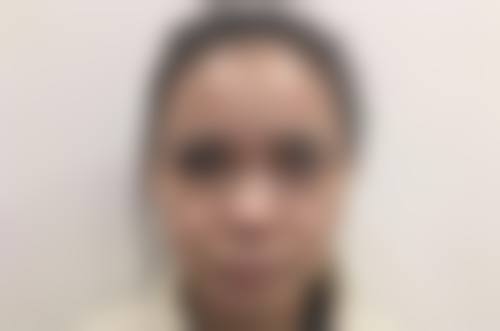 敏感肌使用生姜敷眼袋的注意事项