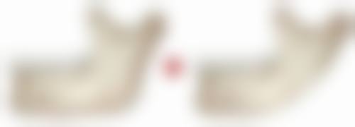 合肥市第二人民医院揭晓双眼皮增生用疤克去掉的至佳时间