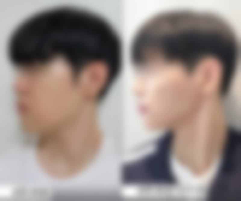 生姜可以敷眼袋吗？3天速效消肿真相，敏感肌必看注意事项！